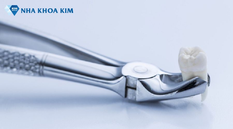 Hình ảnh chân răng khôn sau khi nhổ