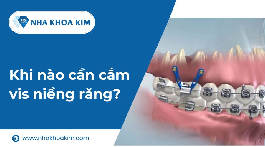 Khi nào cần cắm vis niềng răng?