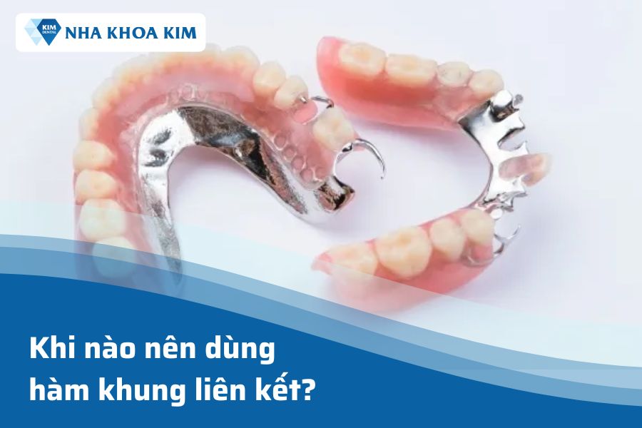 Khi nào nên sử dụng hàm khung liên kết?