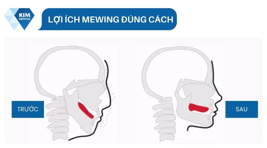 Lợi ích tập Mewing đúng cách 