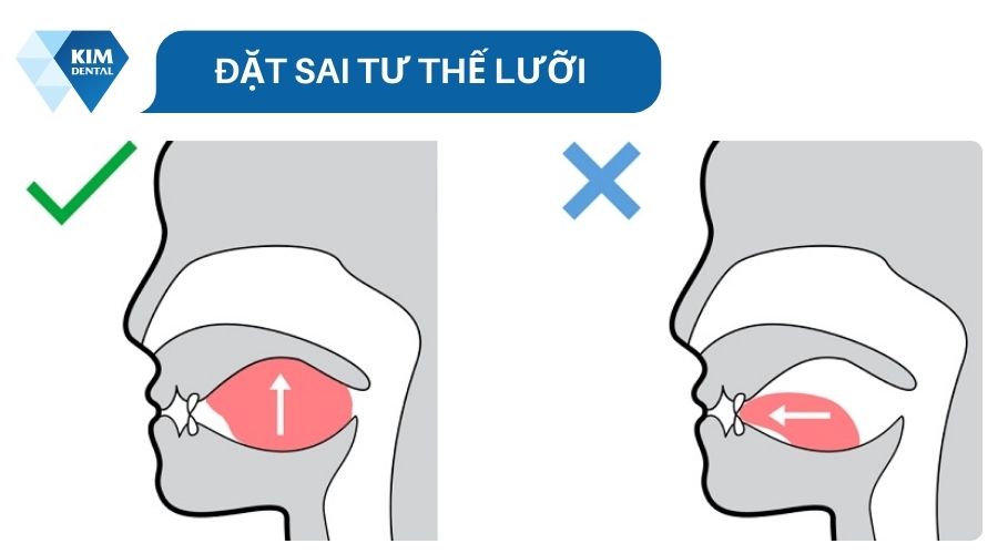 Những lỗi thường gặp khi tập Mewing