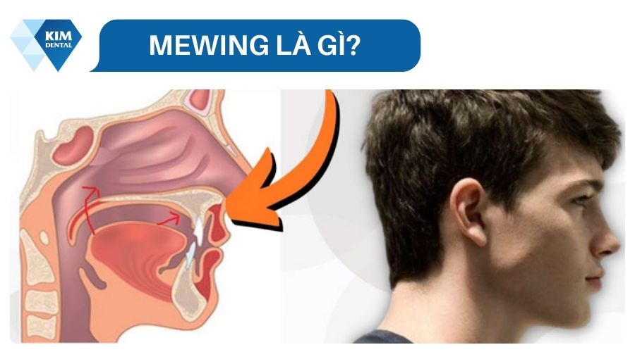 Mewing là gì?