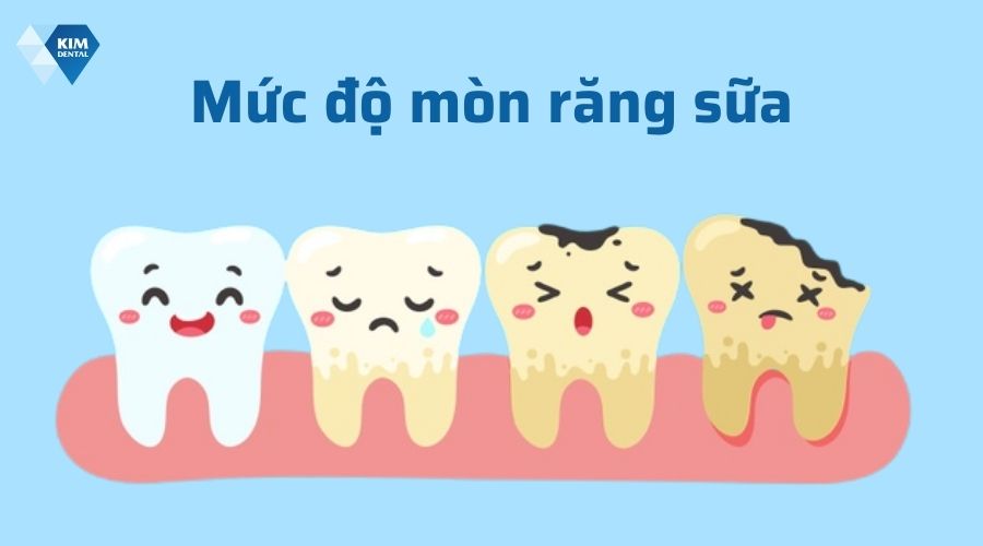 Mức độ mòn răng sữa