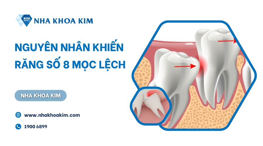 Nguyên nhân răng số 8 mọc lệch