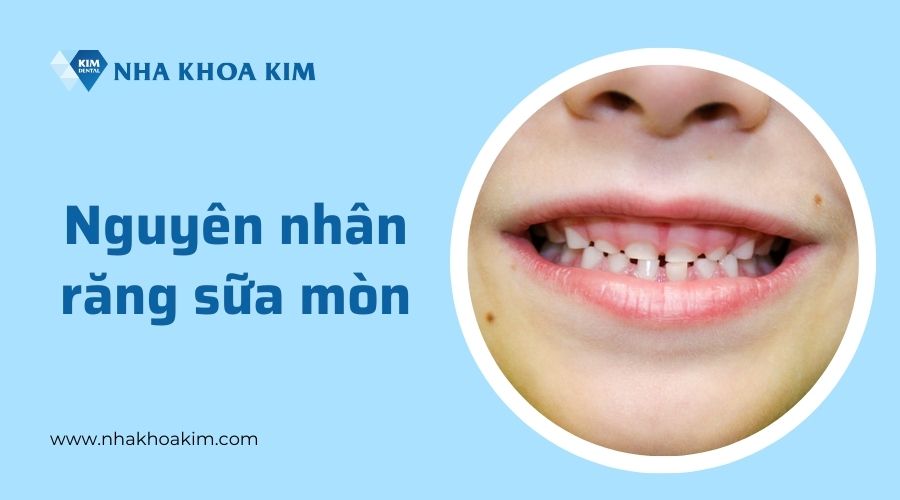 Nguyên nhân răng sữa bị mủn, mòn