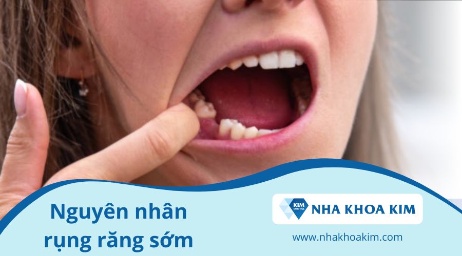 Nguyên nhân rụng răng sớm