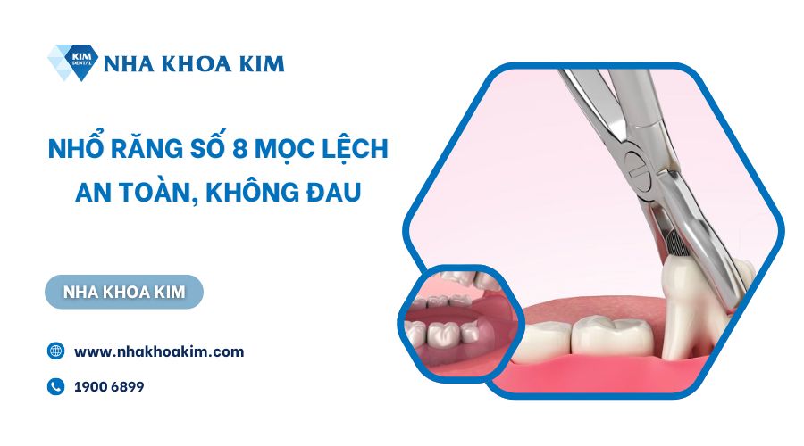 Địa chỉ nhổ răng số 8 mọc lệch không đau, an toàn