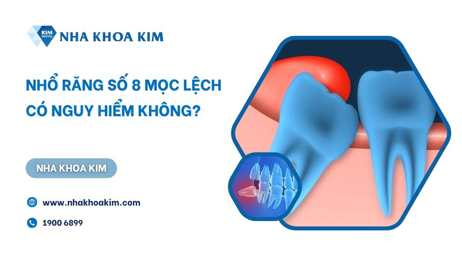Nhổ răng số 8 mọc lệch có nguy hiểm không?