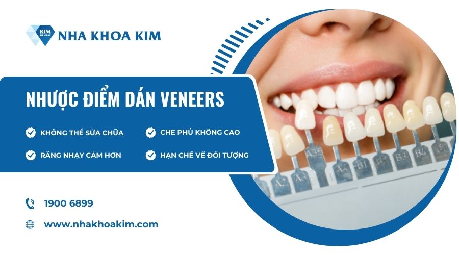 Nhược điểm của veneers
