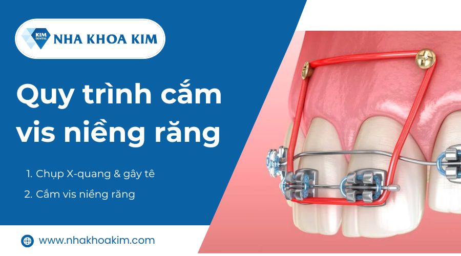 Quá trình cắm vis niềng răng