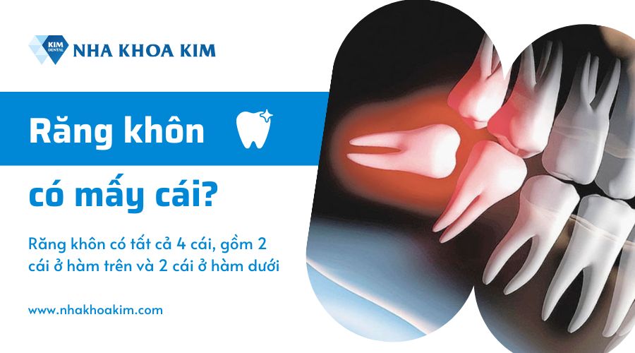 Răng khôn có mấy cái?