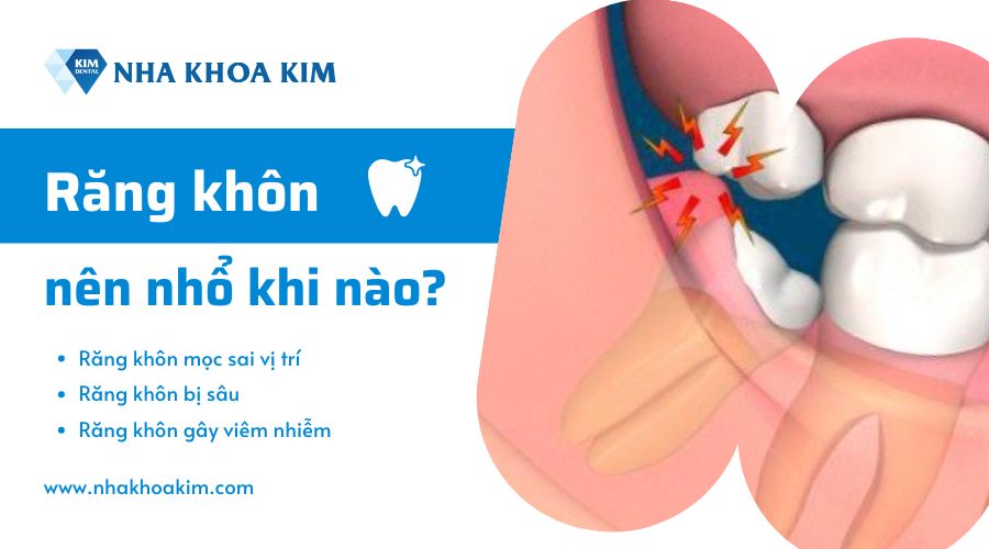 Có nên nhổ răng khôn không