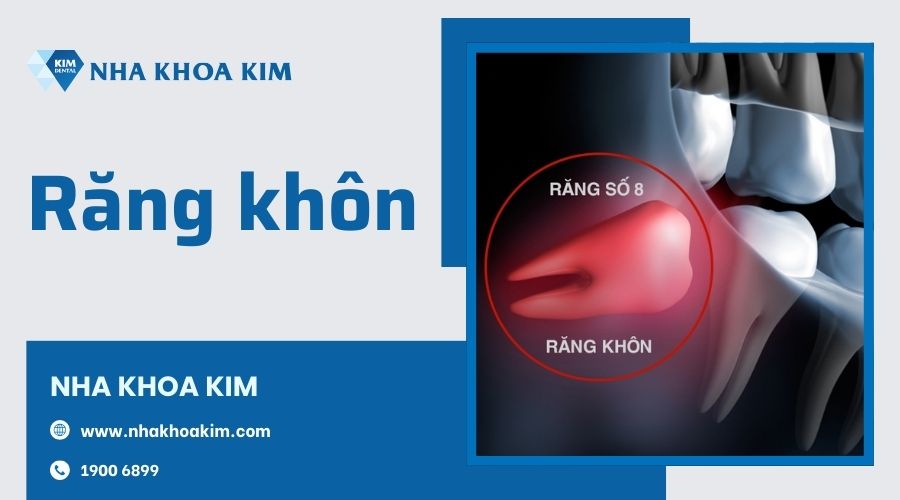 Răng khôn là răng như thế nào?