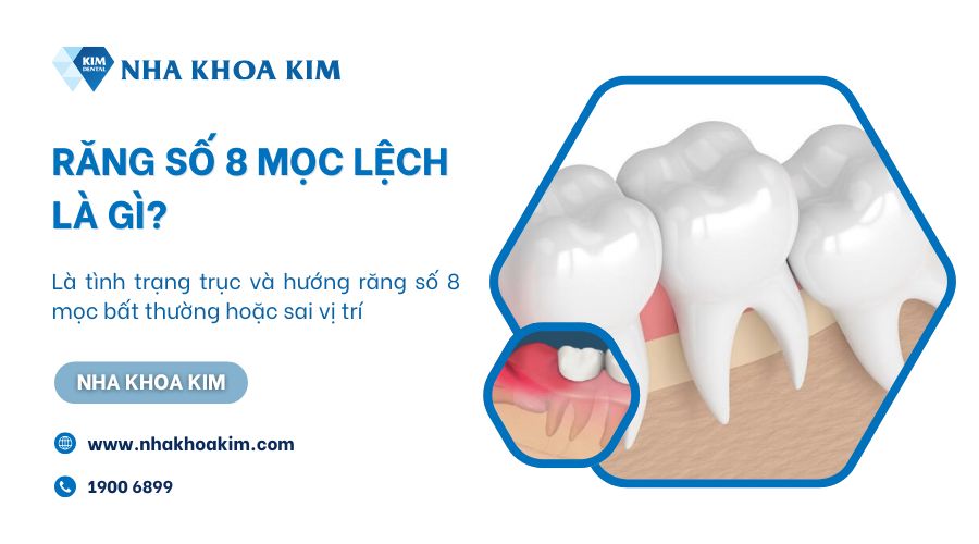 Răng số 8 mọc lệch là gì?