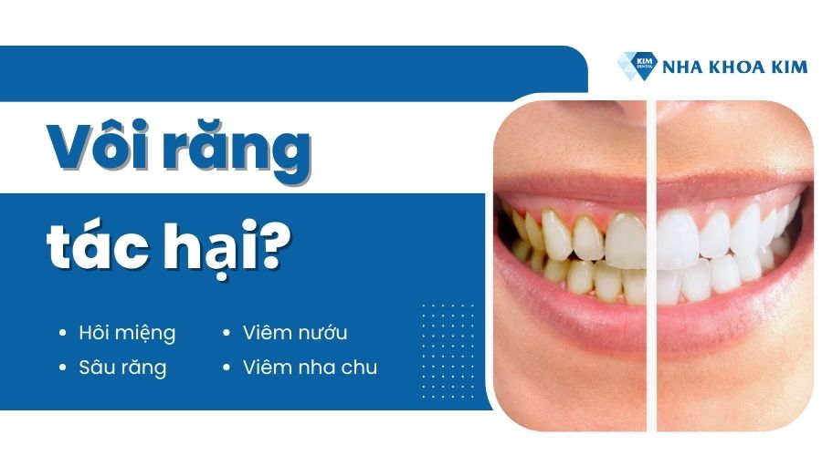 Tác hại của vôi răng