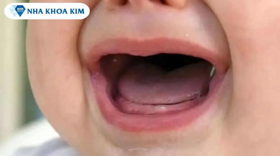 Hình ảnh nhận biết trẻ đi tướt mọc răng