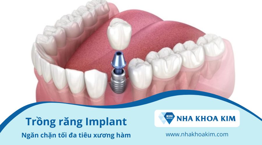 Trồng răng implant khắc phục tình trạng rụng răng