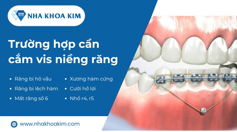 Những trường hợp cần cắm vít niềng răng