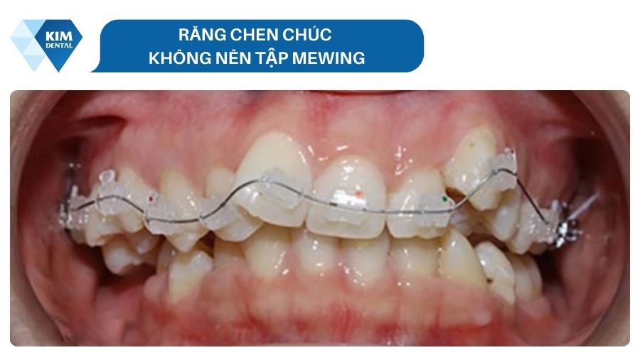 Trường hợp không nên tập Mewing