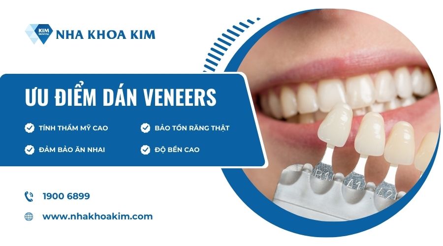 Ưu điểm của Veneers