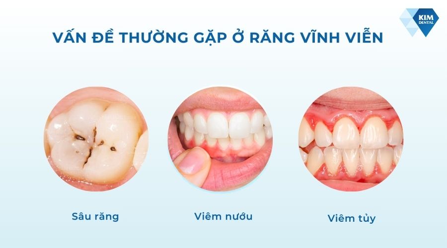 Các vấn đề thường gặp ở răng vĩnh viễn
