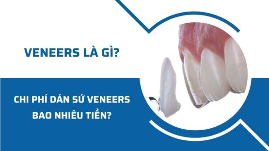 Veneers là gì? Chi phí dán răng sứ Veneers bao nhiêu tiền?