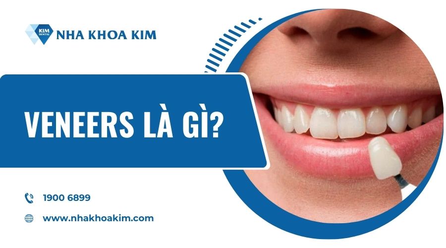 Dán sứ veneers là gì?