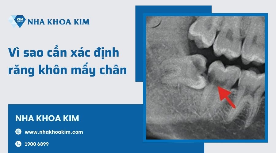 Vì sao cần xác định răng khôn có mấy chân?