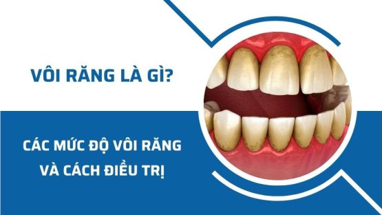 Vôi răng là gì? Các mức độ vôi răng và cách điều trị