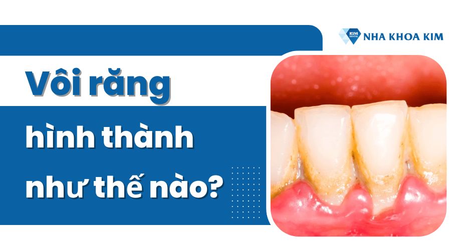 Vôi răng hình thành như thế nào?