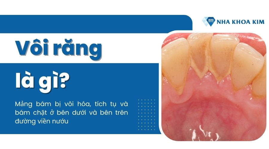 Vôi răng là gì?