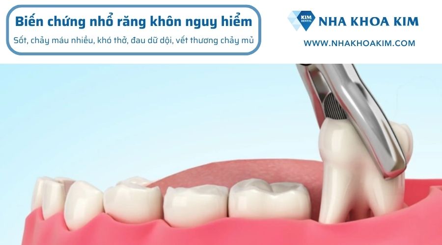 Cách nhận biết biến chứng nguy hiểm sau khi nhổ răng khôn