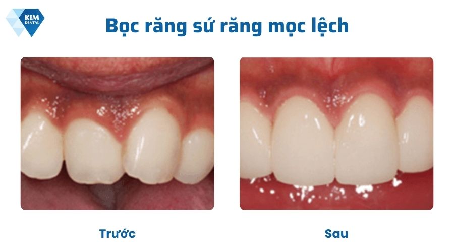 Bọc răng sứ chỉnh răng mọc lệch không cần niềng