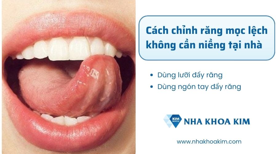 Cách chỉnh răng mọc lệch không cần niềng tại nhà