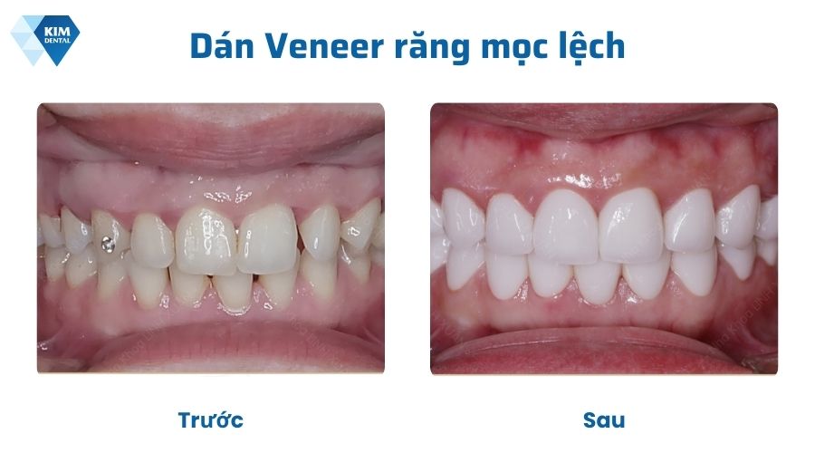 Dán sứ Veneer chỉnh răng mọc lệch không cần niềng