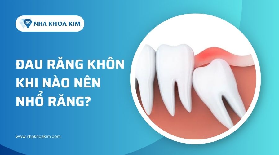 Đau răng khôn khi nào nên nhổ răng?