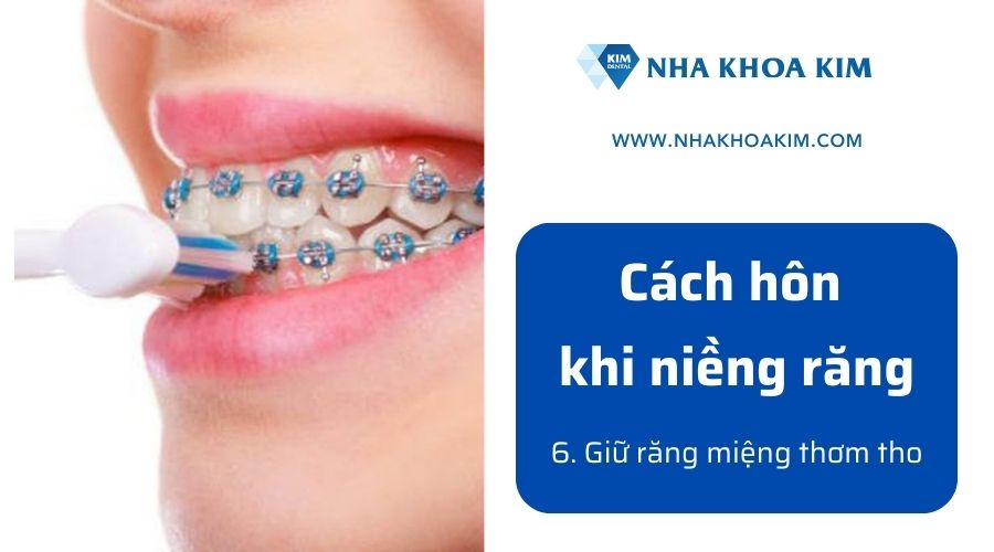 Mẹo hôn nhau khi niềng răng