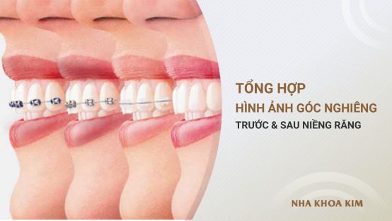 Hình ảnh góc nghiêng trước và sau khi niềng răng