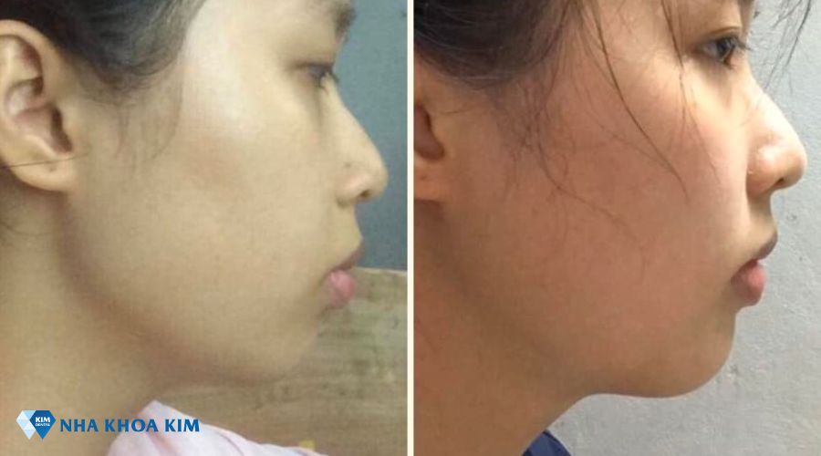 Hình ảnh góc nghiêng thay đổi trước và sau khi niềng răng