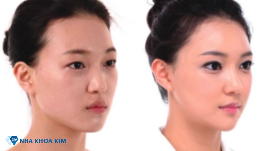 Hình ảnh niềng răng làm thay đổi góc nghiêng gương mặt
