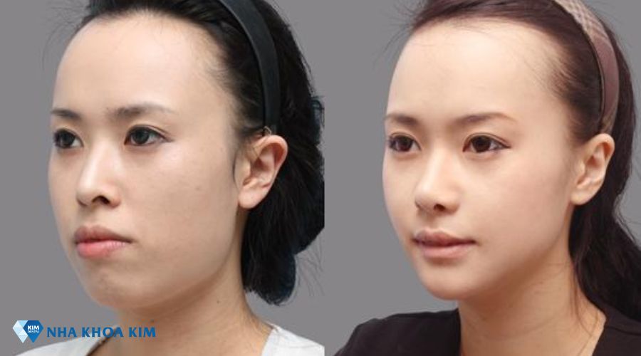 Hình ảnh góc nghiêng của môi và cằm sau khi niềng răng