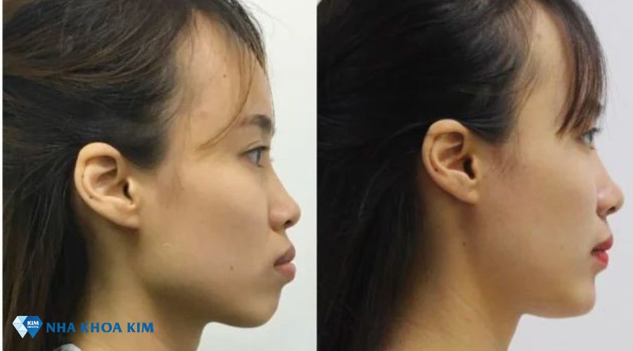 Sự thay đổi của góc nghiêng trước và sau khi niềng răng