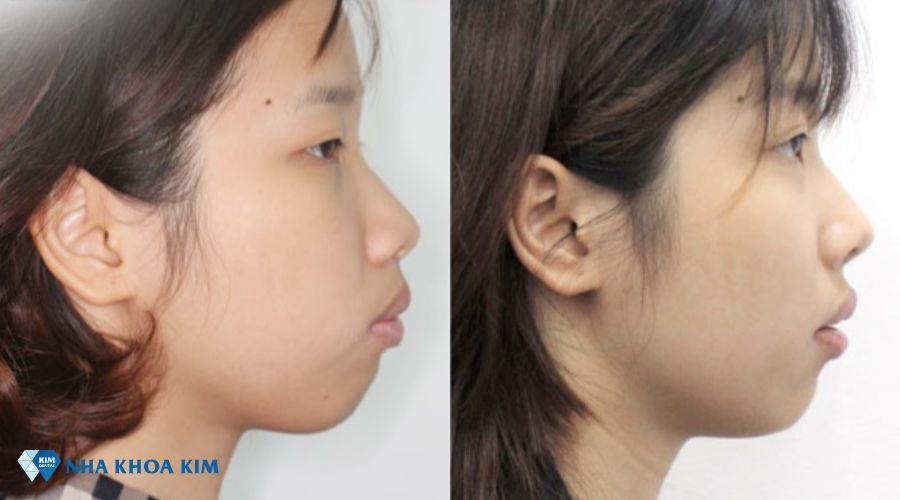 Hình ảnh góc nghiêng trước và sau khi niềng răng hô nhẹ