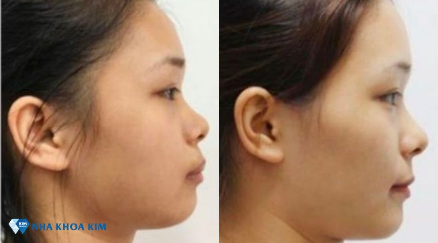 Hình ảnh góc nghiêng của mũi trước và sau khi niềng răng