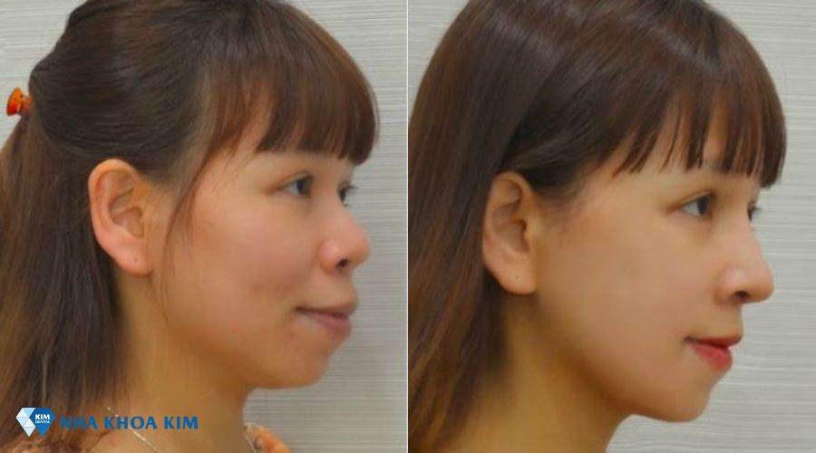 Hình ảnh góc nghiêng trước và sau khi niềng răng hô nặng