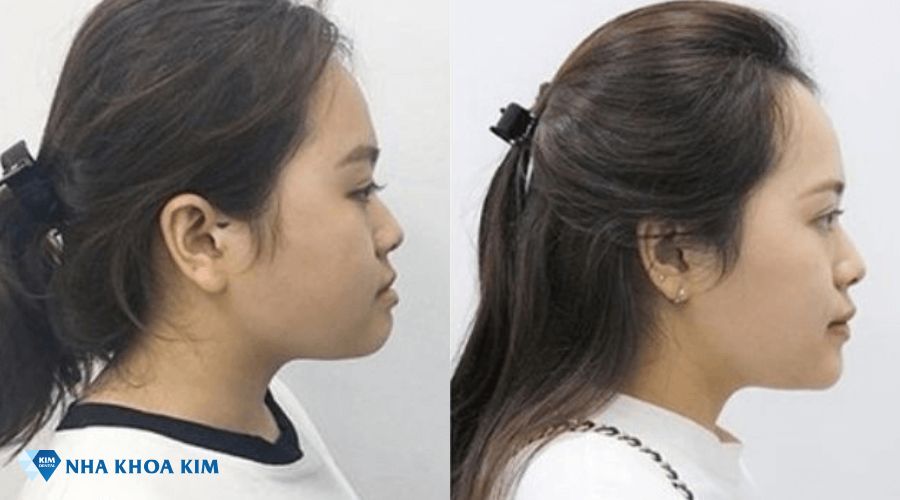 Thay đổi của góc nghiêng trước và sau khi niềng răng