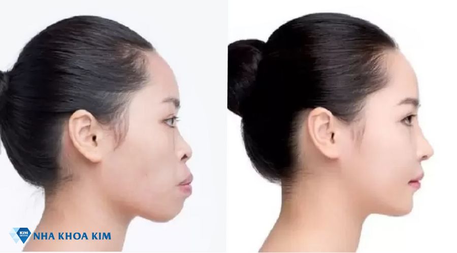 Hình ảnh thay đổi của góc nghiêng trước và sau khi niềng răng móm