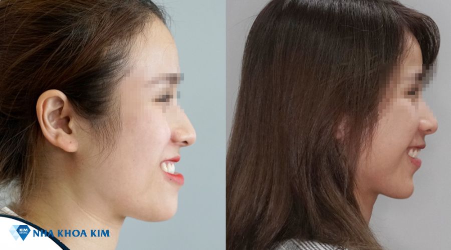 Hình ảnh thay đổi của cằm trước và sau khi niềng răng