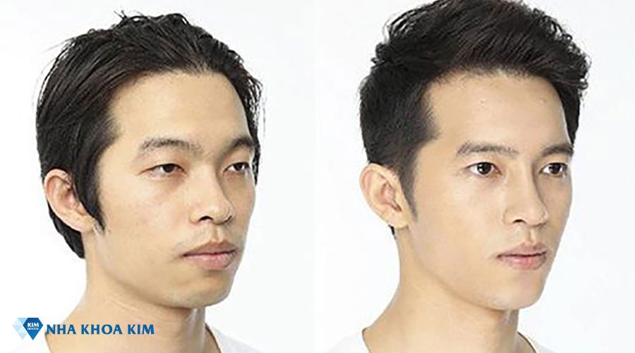 Hình ảnh thay đổi của mũi và cằm trước và sau khi niềng răng