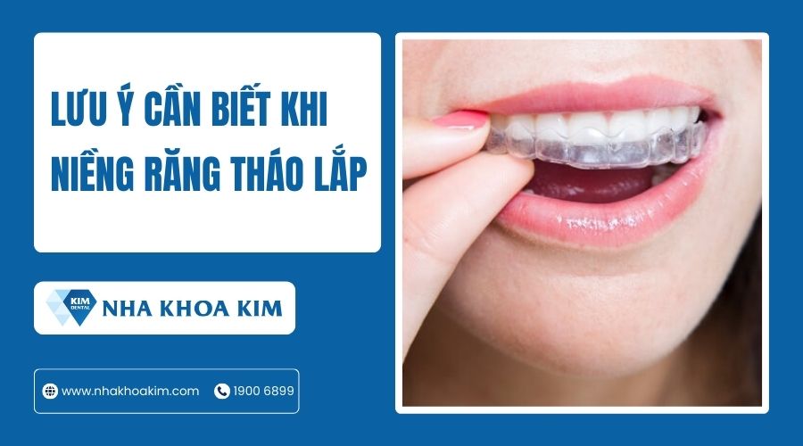Lưu ý cần biết khi niềng răng tháo lắp